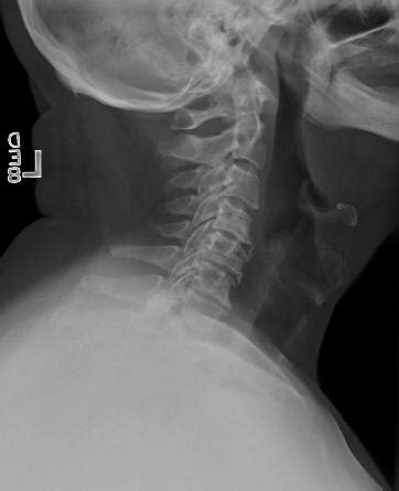 Incomplete Spinal Cord Injuries Spine Orthobullets Hot Sex Picture