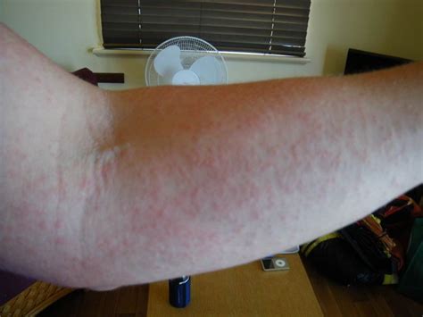 Psa Your Sunheat Rash May Be A Reaction To The Chemicals In Your