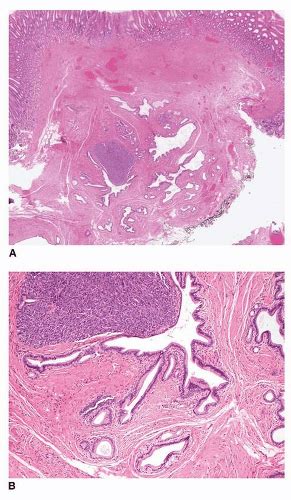 Gastric Polyps Oncohema Key