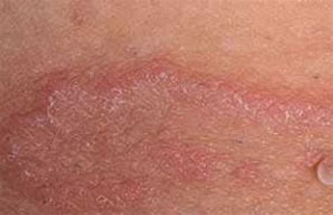 What Is Jock Itch And What To Do About That Red Itchy Penile Skin