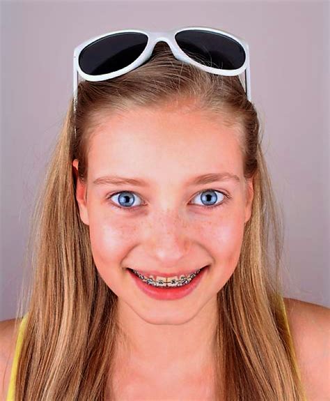 Pin By John Beeson On Girls In Braces In Beautiful Smile