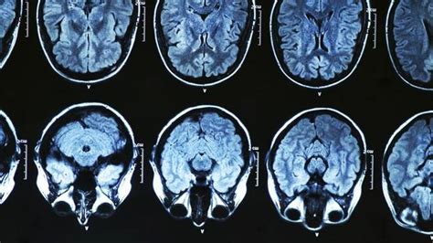 Us Doctors Wake Coma Patient By Jump Starting His Brain Using A New