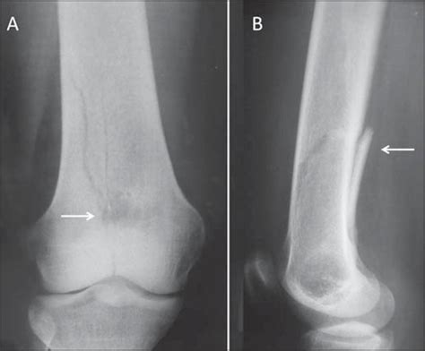Scielo Brasil Knee Bone Tumors Findings On Conventional Radiology