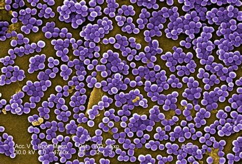 Free Picture Methicillin Resistant Staphylococcus Aureus Infections