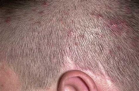 Im Concern About My Small Red Spots Appearing On My Scalp Is This