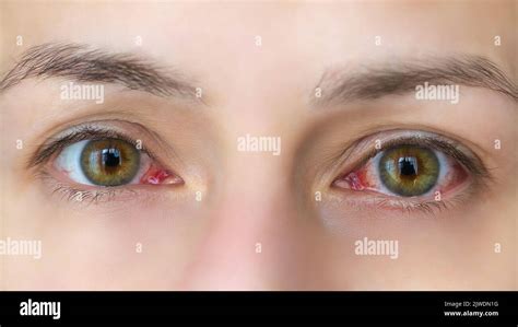 Sore Red Eyes Woman Hi Res Stock Photography And Images Alamy