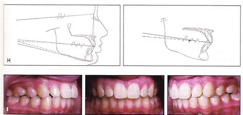 Optimum Teeth Positioning Based On Maxillary Incisors