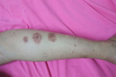 Close Up Of Skin On Legs Of Women With Skin Diseases Allergies Rash