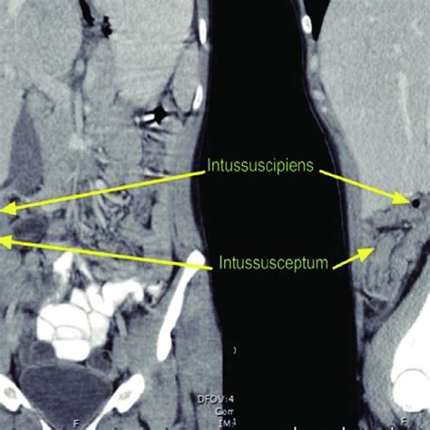 Sonographic Findings Of Intussusceptions Fig 2 Computed Tomography