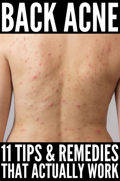 How To Get Rid Of Back Acne 11 Tips And Remedies That Work Acne