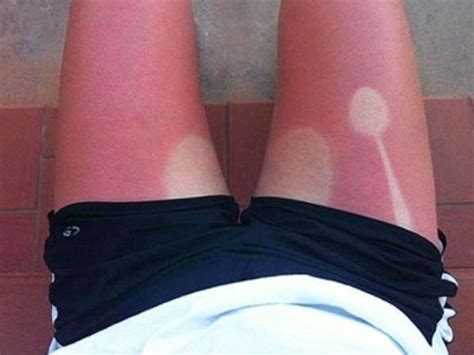 Worst Sunburn Lines