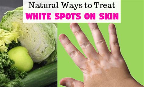 Home Remedies For White Spots On Skin Best 10 Natural Ways To Treat It