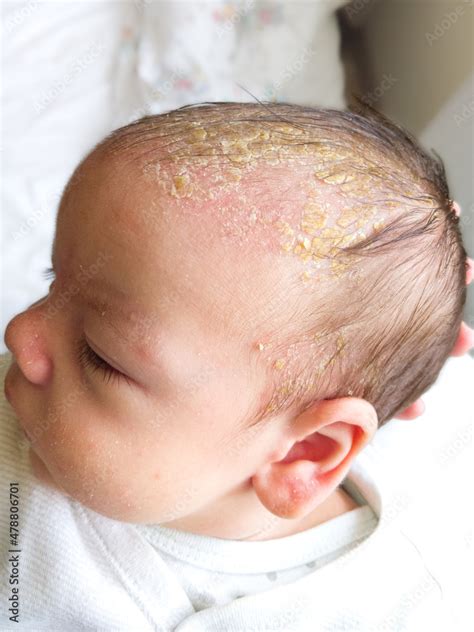 Newborn Baby With Symptoms Of Cradle Cap Dermatitis Seborrhoicum