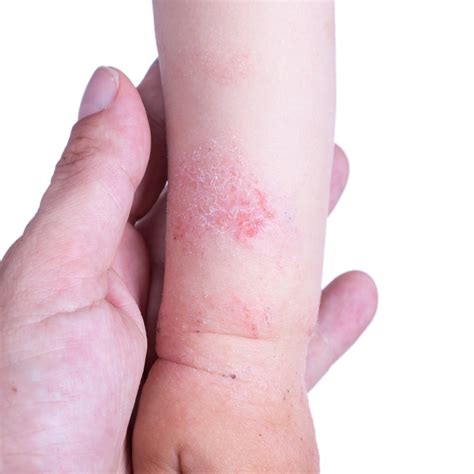 Eczema Advice For The Winter Get Your Happy Baby Back The Mummy Tribe