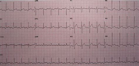 St elevation may also be seen as a manifestation of prinzmetal's (variant) angina (coronary artery spasm). Pericarditis | almostadoctor