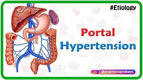 Portal Hypertension Usmle Step 1 Etiology Clinical Features