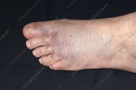 Bruised Foot Following Crush Injury Stock Image M3301721 Science