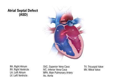 Pin By Nonas Arc On Atrial Septal Defect Asd Atrial Septal Defect