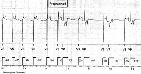 Left Ventricular Systolic Dysfunction Induced By
