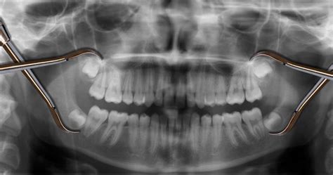 Wisdom Teeth Could Mean Trouble Santa Rosa Oral Surgery