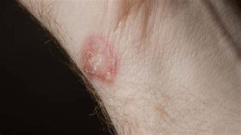 A Ringworm Causing Superfungus Is Infecting People In New York City