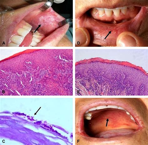 Oral Mucous Squamous Cell Carcinoma—an Anticipated Consequence Of