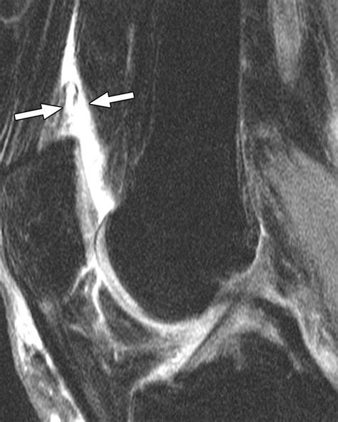 Accuracy Of Cross Table Lateral Knee Radiography For Evaluation Of