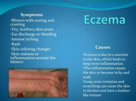 Stages Of Eczema