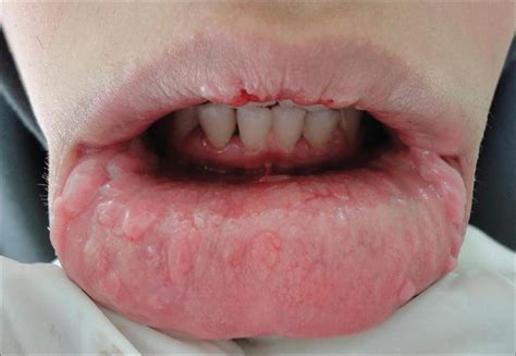 Wart On Lower Lip Pictures