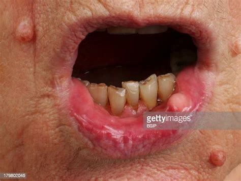 Carcinoma Lesion Photos And Premium High Res Pictures Getty Images