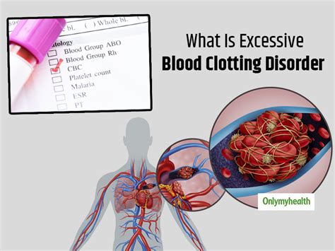 What Is Excessive Blood Clotting Disorder Here Are Its Causes Signs
