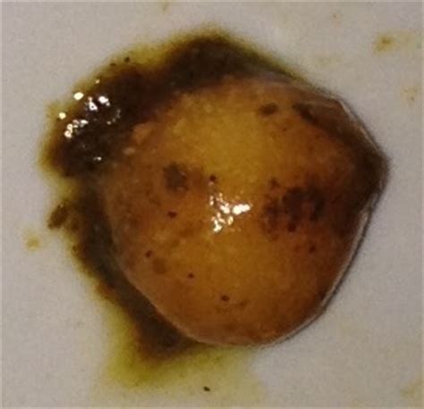 If your stool tests positive for parasites or their eggs, your doctor will prescribe treatment to eliminate the infection. "Egg sac" parasite at Parasites Support Forum (Alt Med), topic 2292984