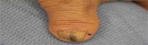 Nail Unit Melanoma In Situ Treated With Mohs Micrographic Su