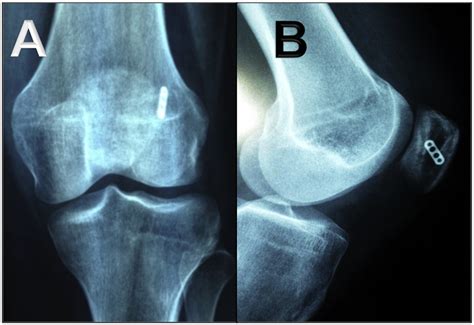 Minimally Invasive Medial Patellofemoral Ligament Reconstruction For
