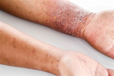 Dermatitis Rash On Hands