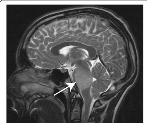 T2 Weighted Sagittal Pediatric Brain Mri Characteristic Diagnostic