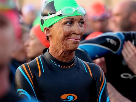 Turia Pitt Instagram Post Reveals Struggles With Surgery And Self