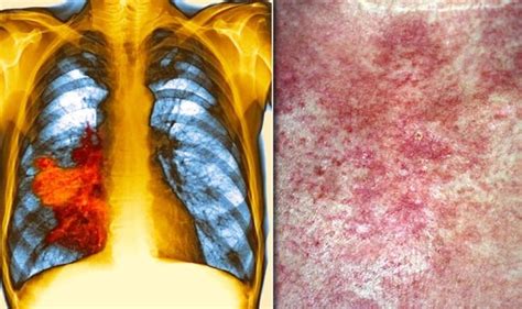 Lung Cancer Symptoms Signs Of A Tumour Include An Itchy Rash On Your Skin Express Co Uk