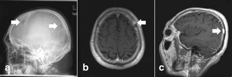 Metachronous Skull Eosinophilic Granuloma Patient 27 Presented With A