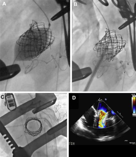 Melody Valve Fracture Causing Mitral Stenosis Novel Solution For