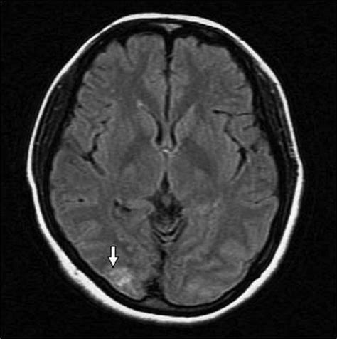 Posterior Reversible Encephalopathy Syndrome Pres In A Patient With