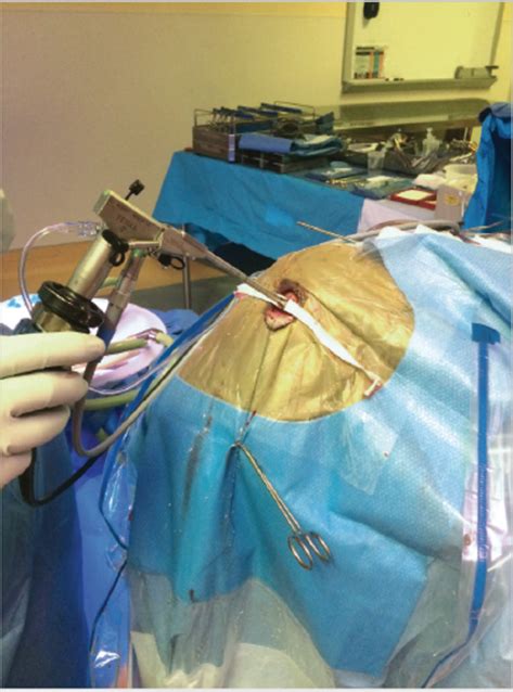 Endoscopic Third Ventriculostomy and Biopsy of Pineal Region | Neupsy Key