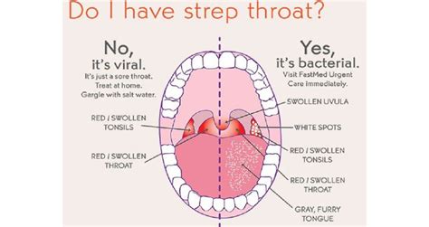 Viral Inflamed Tonsils