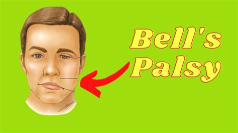 Bell S Palsy Cause Symptoms And Treatment Exercises Physio Mentor