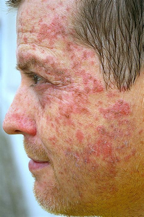 Skin Cancer Signs Symptoms