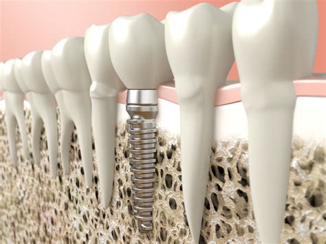 Considering Dental Implants What You Need To Know