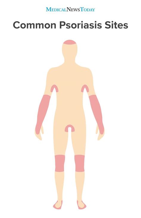 It is characterized by papules, scales & erythema. Psoriasis: Symptoms, types, and treatment