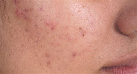 Boil Vs Pimple Tips For Identification
