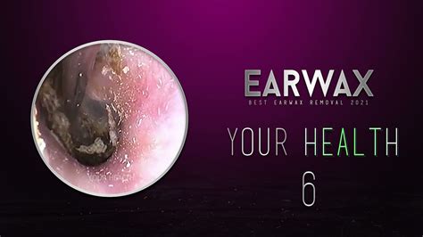 Professional Earwax Removal Youtube