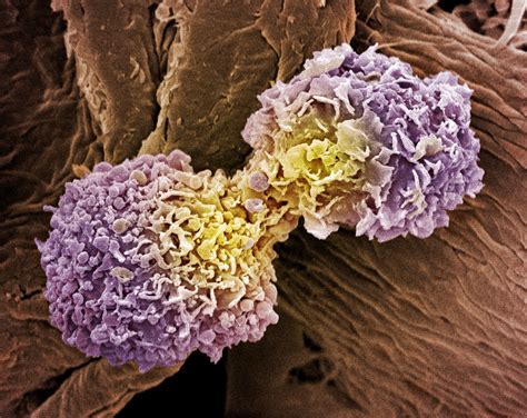 How Breast Cancer Spreads And Recurs